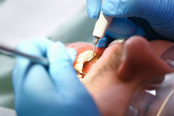 Best Emergency Dental Extractions in Port Jervis, NY