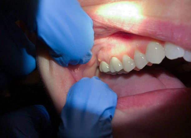 Best Emergency Dentist for Knocked-Out Tooth in Port Jervis, NY